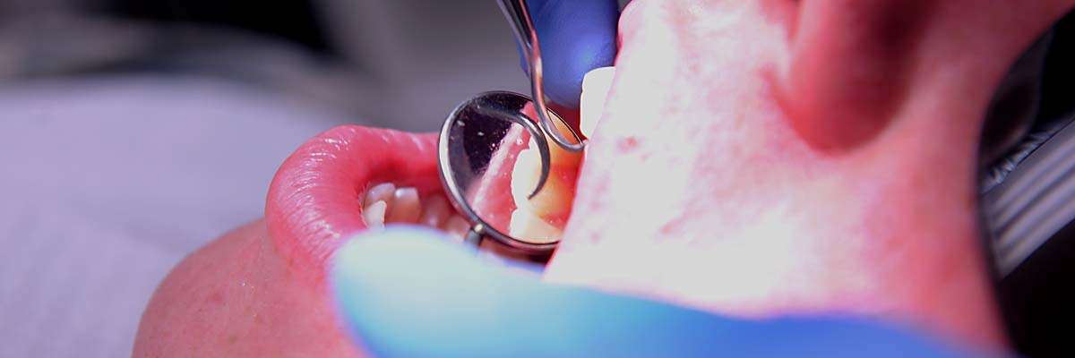 tandartshaakje kopen